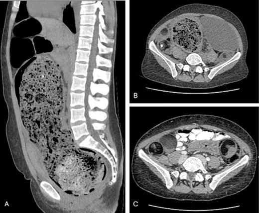 (A) Sagittal view of grossly distended bowel with faecal loading; (B) axial view of dilated distal bowel; (C) axial view of bilateral dermoid cysts.
