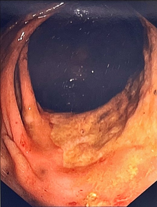 Area of stenosis with fibrotic plaque at 21 cm.