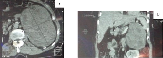 a. CT scan of the abdomen showing a voluminous left adrenal mass (axial section); b. CT scan of the abdomen showing a voluminous left adrenal mass (coronal section).