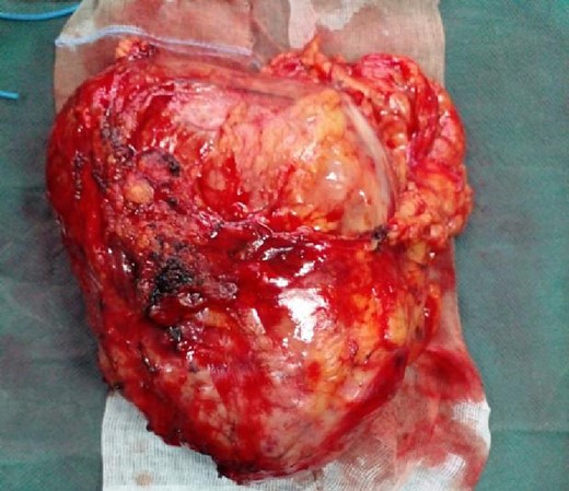 Operation specimen of a left adrenal mass.