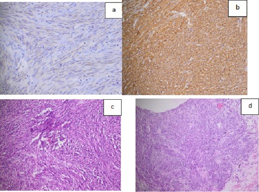 a. Histological image showing the expression of C-kit or CD117 (almost constant in GISTs); b. Histological image showing the expression of CD34 marker; c. Histological expression of DOG 1 marker; d. microscopic image of HE*200 expression.