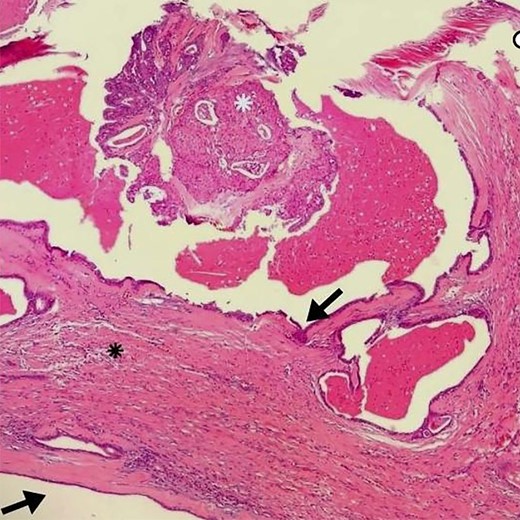 Arrows indicate the wall of a multilocular cyst without atypias. Black asterisk – non-invasive solid area with epidermoid alterations and low-grade atypias. White asterisk – invasive area with squamous and mucinous elements, suggesting the possibility of mucoepidermoid carcinoma. HE, ×4.