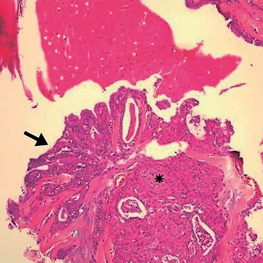 Detail of Fig. 1. Arrow indicates goblet cells and changes indicative of glandular epithelium. (*) area with squamous differentiation. HE, ×10.