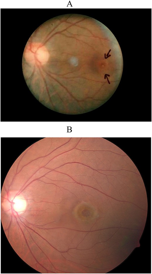 Color fundus photographs of the patient’s left eye taken 30 years earlier (A) and before surgery (B) showing the patient’s full-thickness macular hole.