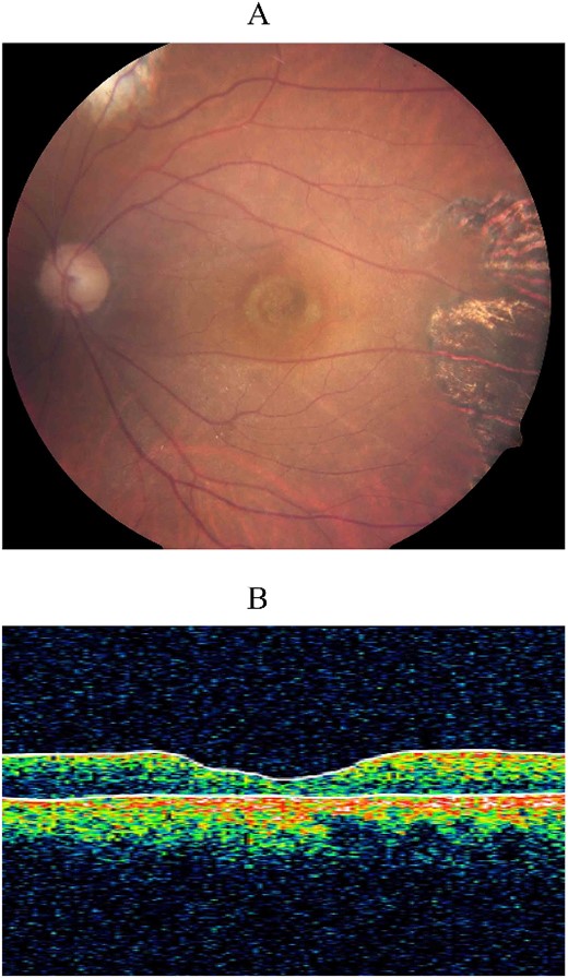 Color fundus photograph (A) and optical coherence tomography (OCT) (B) 3 years post-vitrectomy showing sustained closure of the surgically repaired 30-year-old macular hole. The chorioretinal scarring in the temporal macula was due to laser retinopexy during his second vitreoretinal surgery.