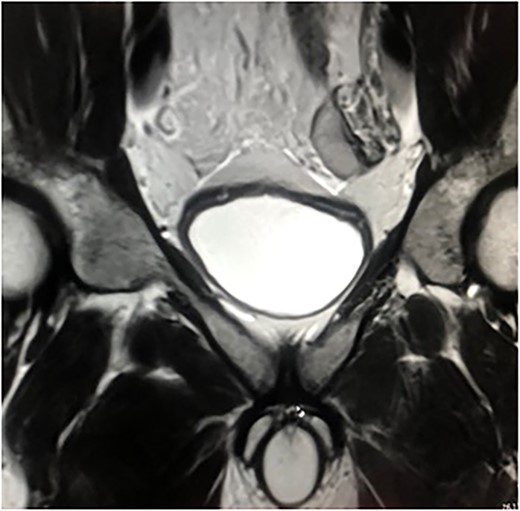MRI of the case. Left testicle is located in the abdominal cavity.