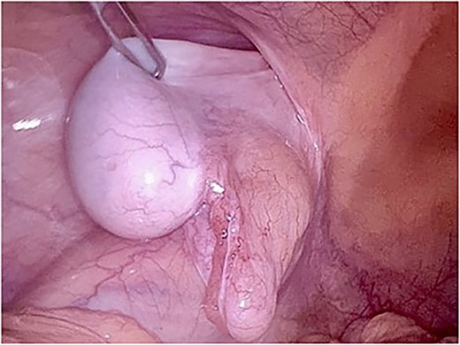 Laparoscopic view of the intraabdominal testicle and the inguinal hernia associated.