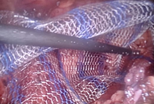 TAPP procedure – lightweight mesh used for the hernia repair.