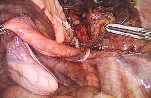 Laparoscopic view of the dissected testicle from the inguinal canal and the hernia sac associated.