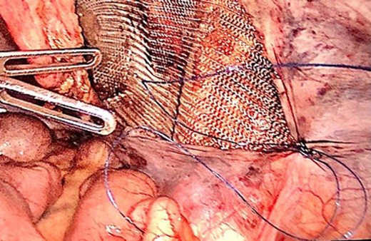 Laparoscopic view of the peritoneal suture in the TAPP procedure performed after orchiectomy.