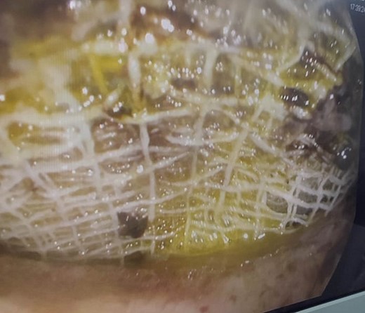 Endoscopy: multiple gauzes are seen in the stomach.