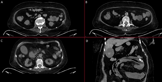 Abdominal CT. (A) An inflated balloon of the Foley catheter is seen in the bowel. (B) An inflated balloon of the Foley catheter is seen in the bowel causing obstruction. (C) The Foley catheter is seen inside bowel loops. (D) Foley catheter inside the bowel.