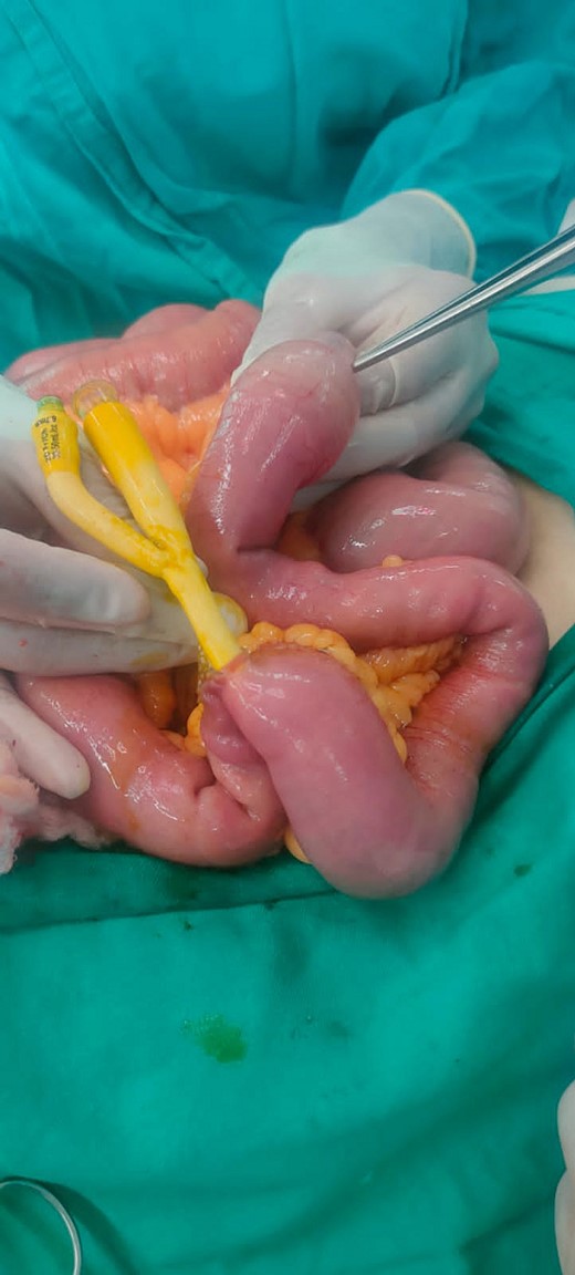 Surgery. The Foley catheter is being removed from the bowel.