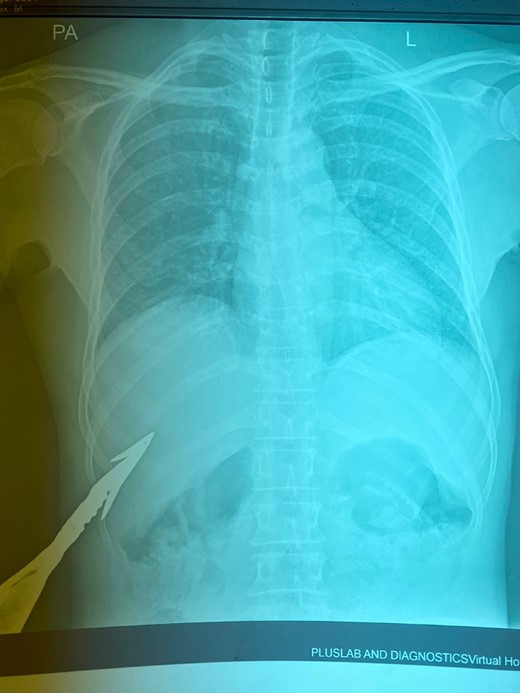 Erect PA chest X-ray (impaled spear in the right hypochondrium).