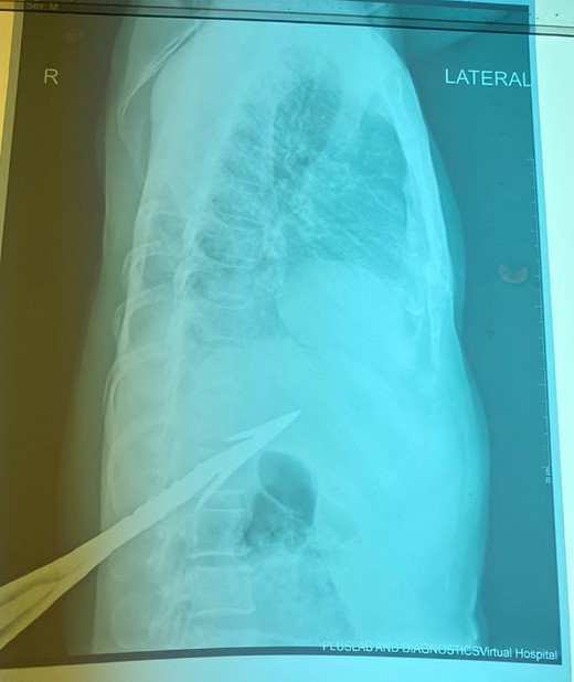 Lateral chest X-ray (impaled spear).