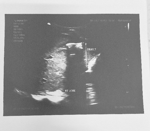 Abdominal ultrasound showing an object with an acoustic shade inside the liver parenchyma.