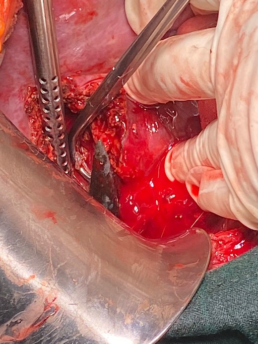 Shows head of the spear during the hepatotomy.