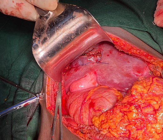 Shows hepatorraphy at segment V of the liver.