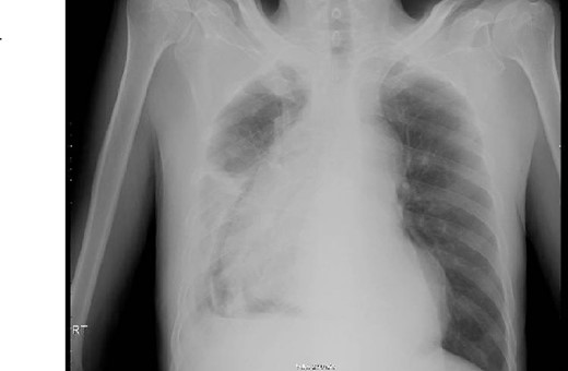 Chest X-ray upon admission.