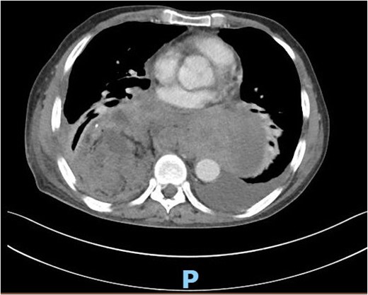 CT scan of the chest showing right large posterior mediastinal heterogeneous soft tissue mass.