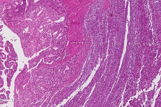 Low power magnification of the esophageal tumor exhibiting the epithelial (left) and the sarcomatous components (right).