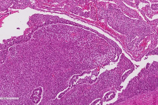 High power magnification of the esophageal tumor showing the adenocarcinoma intermixed with spindle cell sarcoma.