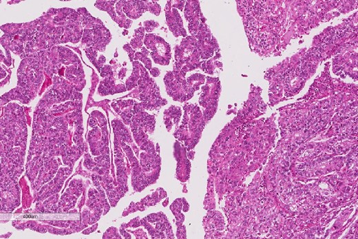 The epithelial component of the esophageal tumor is composed of moderately to poorly differentiated adenocarcinoma.