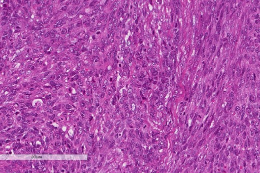 The sarcomatous component of the esophageal tumor is formed of hyperchromatic round to spindle cells with scant cytoplasm and frequent mitoses.