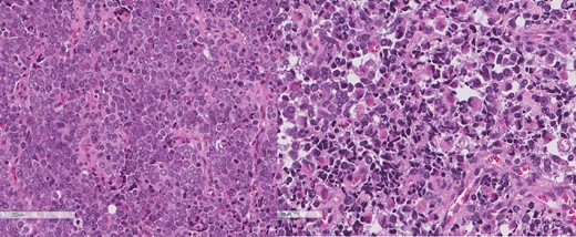 The intrathoracic tumor shows similar morphology to the sarcomatous component of the esophageal tumor, with focal rhabdomyoblastic differentiation.
