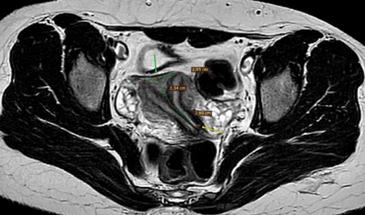 MRI pelvis, axial T2, complete separate uterine cavity (complete septate uterus), two cervices openings (below arrow), no fundal cleft, inter-cornual distance = 29.5 mm (above arrow), the upper 23.5 mm of the septum is composed of myometrium, while the distal 28 mm is composed of fibrous tissue.