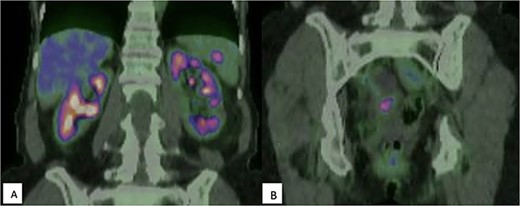 (A) FDG-PET demonstrating moderately intense (SUVmax 5.6) uptake within the spleen, suspicious for malignancy; (B) Multicystic pelvic lesion with solid component (SUVmax 4.0).