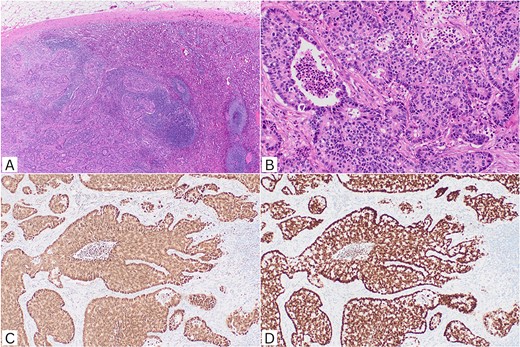 Histopathological features. (A) Metastatic adenocarcinoma infiltrating splenic parenchyma (H&E, ×40). (B) Irregular cribriform glands with luminal necrosis in keeping with colorectal origin (H&E, ×200). (C) CDX2 nuclear positivity (IHC, ×100); (D) SATB2 nuclear positivity (IHC, ×100). H&E: haematoxylin and eosin; IHC: immunohistochemistry.