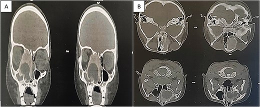 CT showing an expansible, well-demarcated, osteolytic lesion with a peripheral sclerotic rind on the right side of the ethmoid bone, expanding into the ipsilateral nasal cavity, orbit, and maxillary sinus; (A) coronal CT scan; (B) axial CT scan.