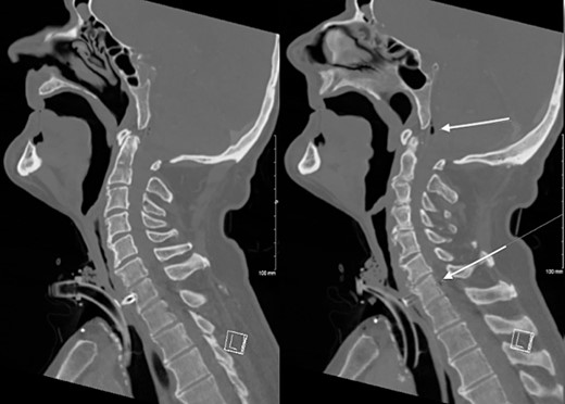 CT Neck demonstrating erosion of TEP into the C7 cervical resulting in osteomyelitis and a gas containing anterior epidural collection.