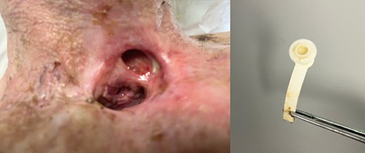 Clinical photograph of laryngectomy stoma and tracheoesophageal prosthesis.