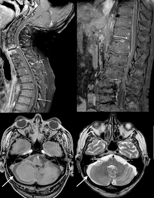 Initial MRI brain and whole spine demonstrating vertebral C6-C7 osteomyelitis (dotted arrow), subdural abscess within the cerebellum (bold arrow), and an epidural abscess within the spinal canal (arrow).