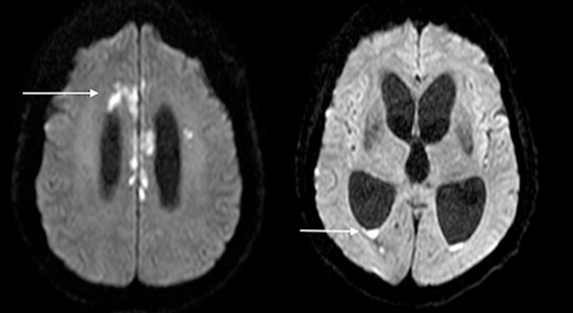 Diffusion-weighted MRI-brain showing intensely high signal in cerebral cortex (arrow) and ventricles (arrow) consistent with infective cerebritis and ventriculitis.
