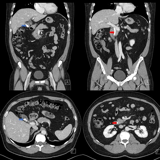 Contrast-enhanced CT demonstrating limy bile within the gallbladder neck (left image) and CBD (right image).