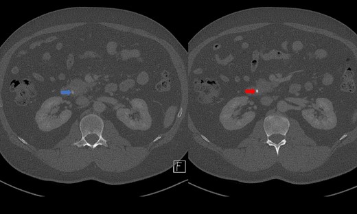 CT demonstrating an obstructing calculus (right image) present within the CBD distinct from the limy bile (left image) (WW 2249, WL 450).