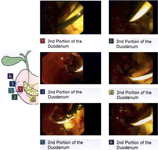 Intraprocedural images during ERCP demonstrating chalky limy bile.