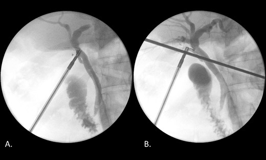 (A) IOC demonstrating a distal filling defect in the CBD causing partial occlusion. (B) IOC following TCBDE demonstrating no remaining filling defect with tapering of the distal CBD with contrast flow to the duodenum.