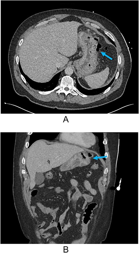 (A) Axial CT and (B) coronal reconstruction demonstrating perforated gastric ulcer at the greater region of the gastric body (arrows).
