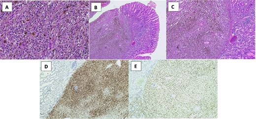 H&E and IHC stains of the histopathology specimens demonstrating malignant melanoma in the surgically resected specimen. (A) Malignant melanoma with cells showing atypical nuclei, prominent nucleoli and melanin pigment (high power H&E). (B) Normal small bowel mucosa with submucosal melanoma (low power H&E). (C) Submucosal melanoma with melanin pigment. (D) Melanoma cells positive for Melan-A. (E) Melanoma cells positive for SOX10.