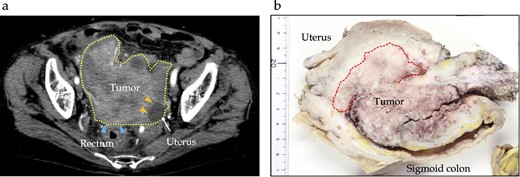 Preoperative and pathological findings of sigmoid carcinoma. (a) Contrast-enhanced computed tomography reveals a hypodensity mass (dotted line) of ~12 cm, located in the sigmoid colon, suspiciously invading the rectum (arrows) and uterus (yellow arrows). (b) Macroscopic findings reveal a type 1 tumor measuring 130 × 40 × 25 mm in the sigmoid colon, with direct invasion into the uterine corpus, left ovary, and small intestine.