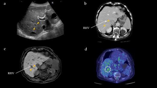 Radiographical findings of Segment 7 lesion in the liver. (a) On abdominal ultrasound, a hypoechoic tumor, measuring 10 mm (arrows), is identified in Segment 7. (b) Contrast-enhanced computed tomography indicates a 10 mm, hypodensity lesion located in Segment 7 (arrows) at portal phase. This lesion is close to the RHV. (c) Gadoxetic acid-enhanced magnetic resonance imaging shows a 10 mm, hypointensity lesion (arrows) in Segment 7 adjacent to the RHV at hepatic phase. (d) PET/CT reveals FDG accumulation (maximum standardized uptake value, SUVmax = 3.91) in the Segment 7 nodule.