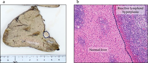 Pathological findings of RLH of the liver. (a) In the macroscopic findings, a whitish, 10 mm tumor is observed in Segment 7 of the liver (dotted line). (b) Microscopic findings show lymphocyte clusters with multiple germinal centers without any atypical lymphocytes, suggesting RLH. No residual lesions are seen on the resection margin.