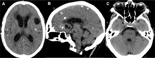 Initial brain CT revealed multiple calcified cysts with ventriculomegaly in the axial (A, C) and sagittal (B) views.