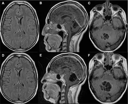Brain MRI one year (A–C) and 14 months (D–F) prior to her current admission. (A–B) T1 sequence depicted multiple cystic lesions in the cerebellum without significant compression of the fourth ventricle; (C) T2 fluid-attenuated inversion recovery (FLAIR) sequence showed slight perilesional edema; (D–E) T1 sequence demonstrated a notable increase in cyst growth along with compression of the fourth ventricle; (F) T2 FLAIR sequence showed increased edema.