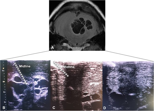 Intraoperative ultrasound-guided resection. (A) Cerebellar MRI is shown upside down for better correlation with the ultrasound view; parasitic cysts correspond to hypointense lesions; (B–D) Echographic views depicted the progression of ultra-sound guided resection with excision of the hypoechoic lesions from the superficial to deep planes.