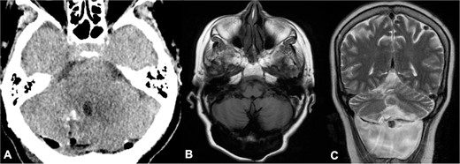 Postoperative head CT and 2-year follow-up brain MRI. (A) Axial view of head CT demonstrated complete resection of cysts; (B–C) 2-year follow-up brain MRI showed no recurrence of parasitic cysts in T1 axial and T2 coronal sequences and a cerebrospinal fluid fistula.
